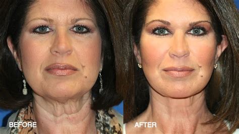 FAT GRAFTING (FAT TRANSFER): FAT INJECTIONS SURGERY IN SING.